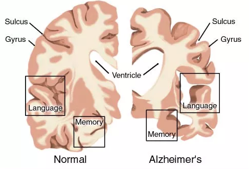 AD药物研发现状：辉瑞、礼来、百健、诺华、强生……