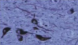 正常人：黑质神经元存在