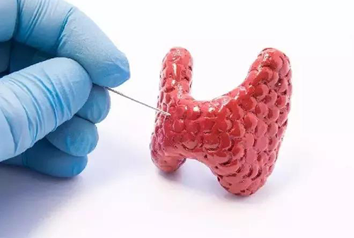 甲状腺疾。鬃聪俟δ芗跬撕图鬃聪俟δ芸航怨乓岳淳褪欠锤幢灰窖а芯咳嗽毖芯康募膊