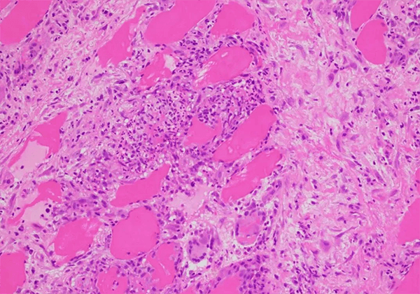 【HJC黄金城平台助力】治疗结节病的KBMAB-16获FDA批准临床