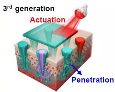 第三代：通过微针介导的皮肤层破坏和微针伴随的各种功能增强药物转运.jpg
